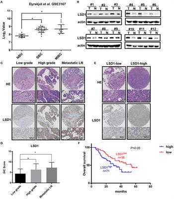 LSD1 Promotes Bladder Cancer Progression by Upregulating LEF1 and Enhancing EMT